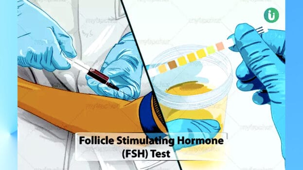 Follicle Stimulating Hormone (FSH) Test
